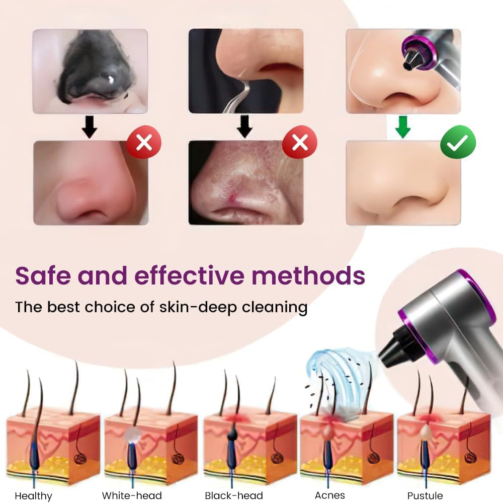 Blackhead Removers Pore Vacuum with Heating，5 Suction Heads & 3 Adjustable Suction Levels ，For Nose & Face Deep Pore Cleansing
